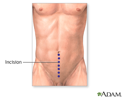 Incision, part 2