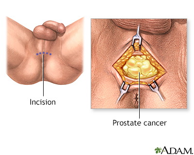Incision, part 1
