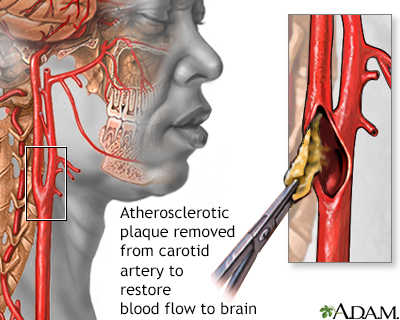 Endarterectomy
