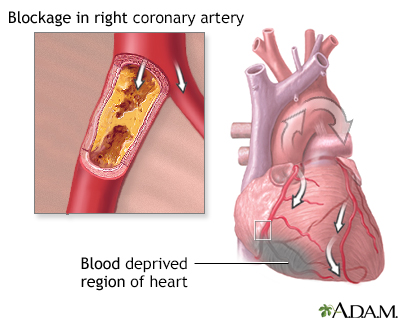 Coronary artery blockage
