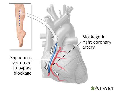 Coronary bypass surgery