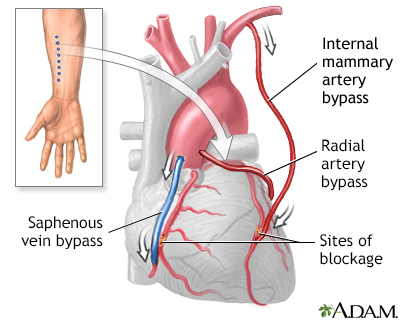 Coronary artery bypass