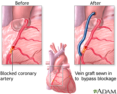 Heart bypass surgery
