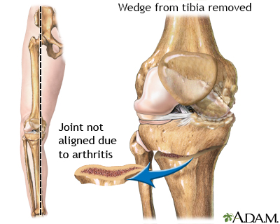 HIE Multimedia - Osteotomy of the knee