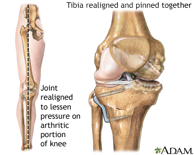 HIE Multimedia - Osteotomy of the knee HIE Multimedia - Osteotomy of the knee